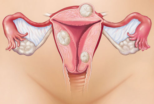 Аденоміоз матки: що це таке, симптоми, ознаки та лікування