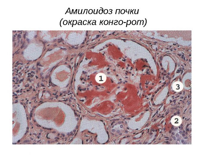 Амілоїдоз нирок: особливості лікування підступної патології
