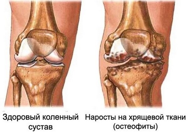 Артроз колінного суглоба – 1, 2, 3 ступеня. Причини, симптоми, лікування, хондропротектори