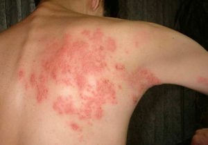 Чому з’являються червоні плями на спині?