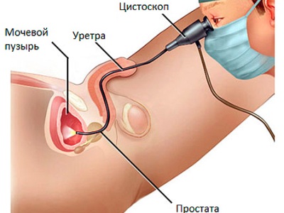 Цистоскопія сечового міхура: опис процедури