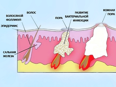 Фурункул і фурункульоз: причини, симптоми і лікування