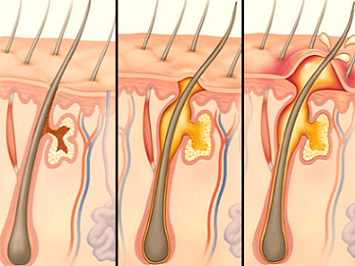Фурункул і фурункульоз: причини, симптоми і лікування