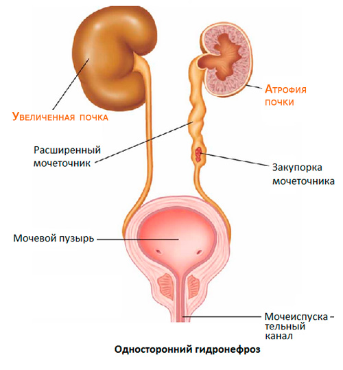 Гідронефроз: як не втратити нирку
