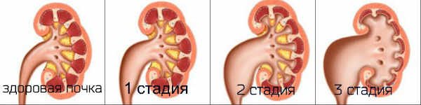Гідронефроз: як не втратити нирку