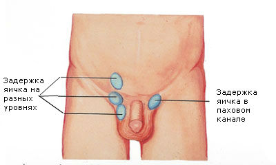 Гіпоплазія яєчок у чоловіків і дітей, фото, причини і лікування