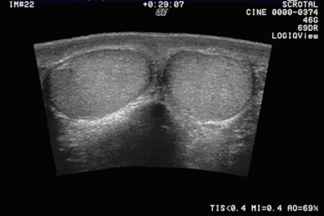 Гіпоплазія яєчок у чоловіків і дітей, фото, причини і лікування