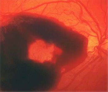 Гемофтальм – крововилив у склоподібне тіло очі
