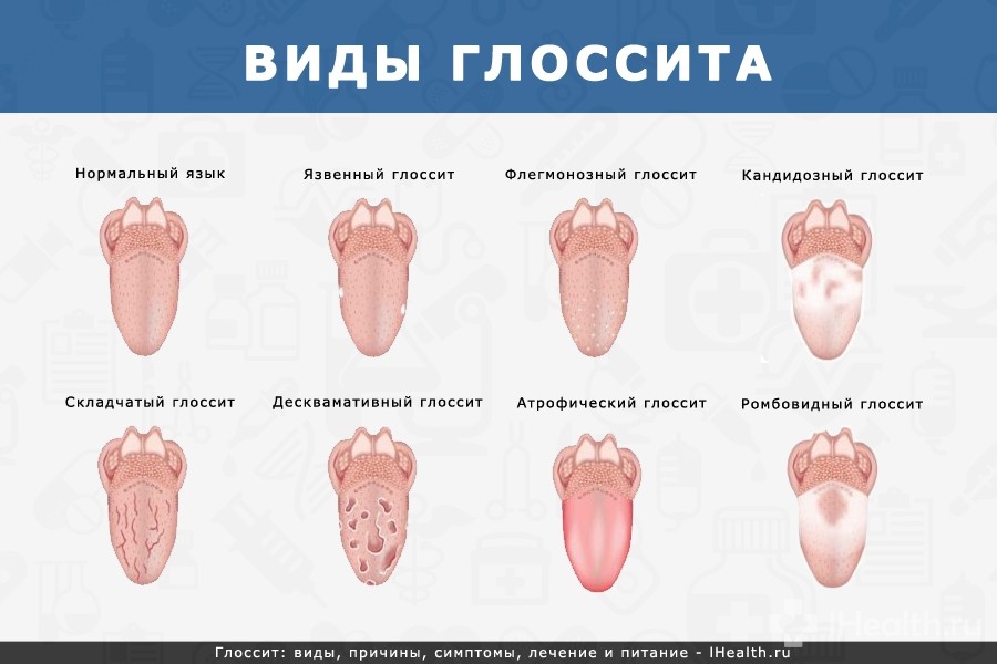 Глосит: причини, фото, симптоми і лікування