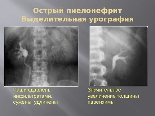 Гострий пієлонефрит: ознаки і лікування