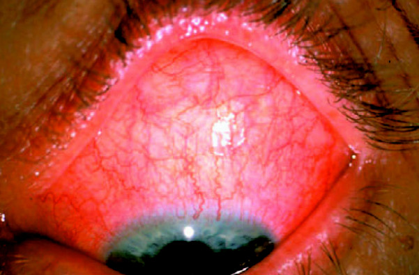 Гострий вірусний кон’юнктивіт очей у дітей та дорослих – Симптоми і лікування вірусного захворювання