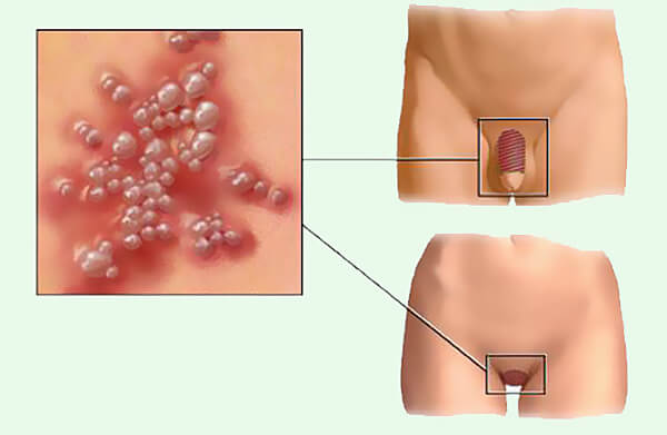 Грибок статевих органів: визначення та шляхи зараження