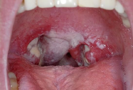 Хламідіоз горла – фото, причини, симптоми і лікування