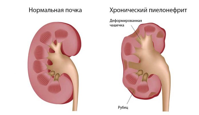 Хронічний пієлонефрит: як лікувати патологію