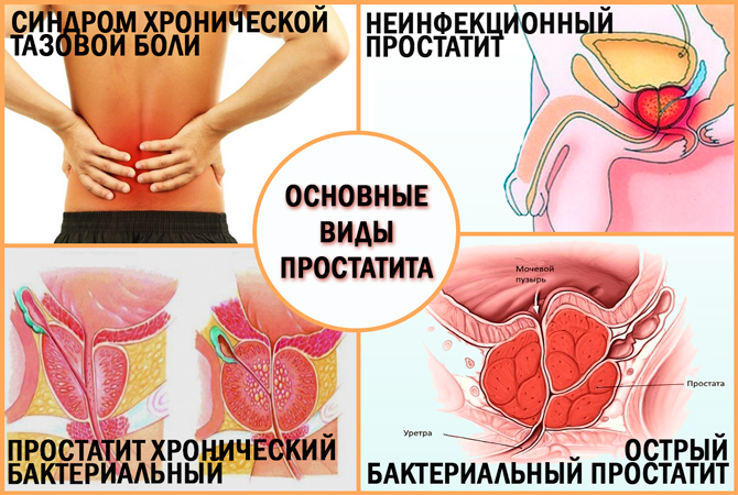 Хронічний простатит: чи можна його вилікувати?