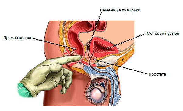 Калькульозний простатит: причини, симптоми і лікування