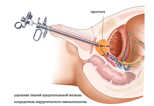 Калькульозний простатит: причини, симптоми і лікування