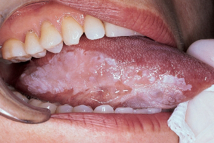 Кандидоз порожнини рота у дітей та дорослих: причини, фото і як лікувати