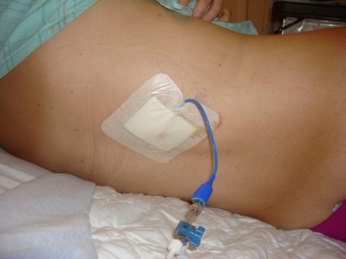 Катетеризація сечового міхура — невідкладна допомога при урологічних патологіях