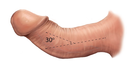 Кривий статевий член – всі причини і хвороби