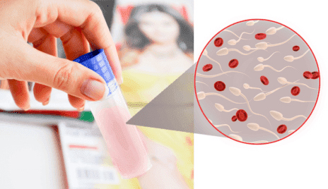 Кров у спермі (домішка або згустки) – причини у чоловіків і як лікувати