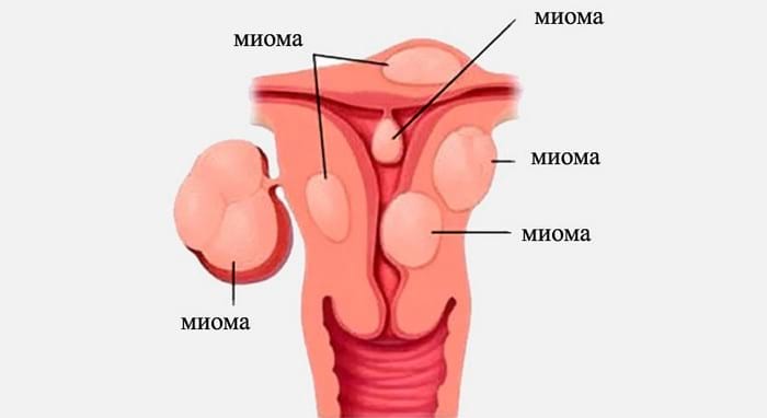 Міома матки: причини, фото, чим небезпечна, симптоми, як лікувати