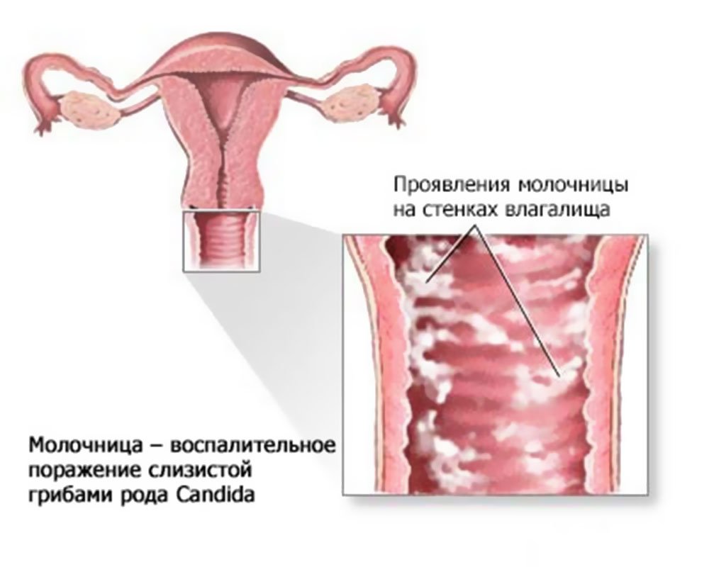 Молочниця у жінок, причини виникнення, симптоми і лікування.