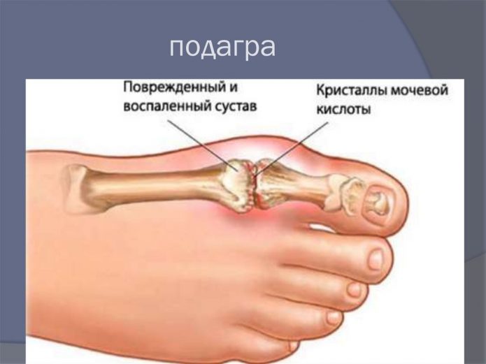 Нефропатія: як врятувати свої нирки від повільної загибелі