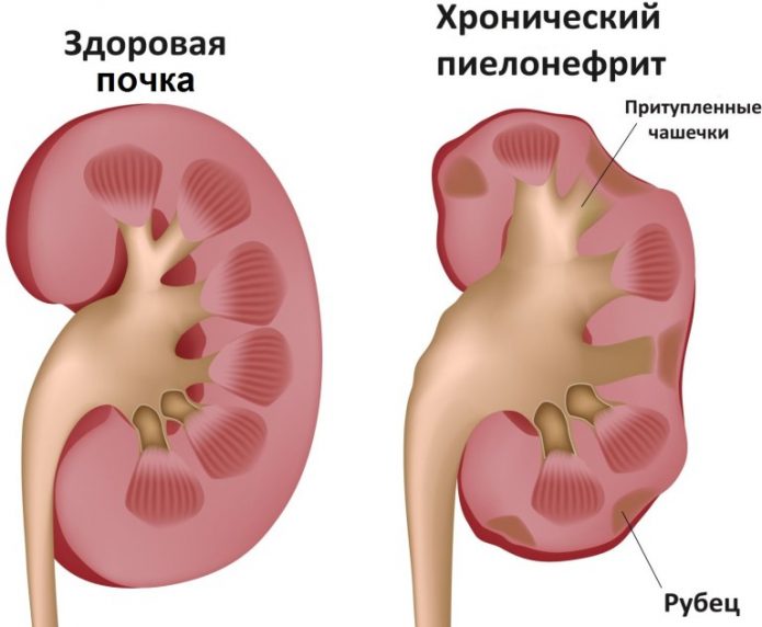 Ниркова недостатність — патологія, що призводить до збою в усьому організмі