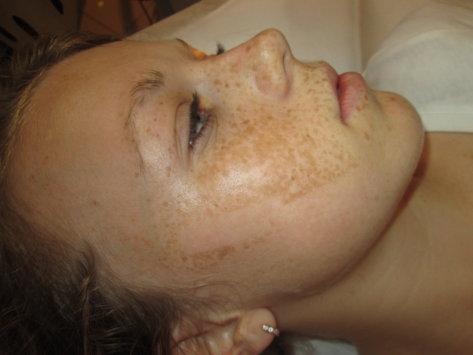 Пігментні плями на обличчі: причини і лікування, як вивести в домашніх умовах?