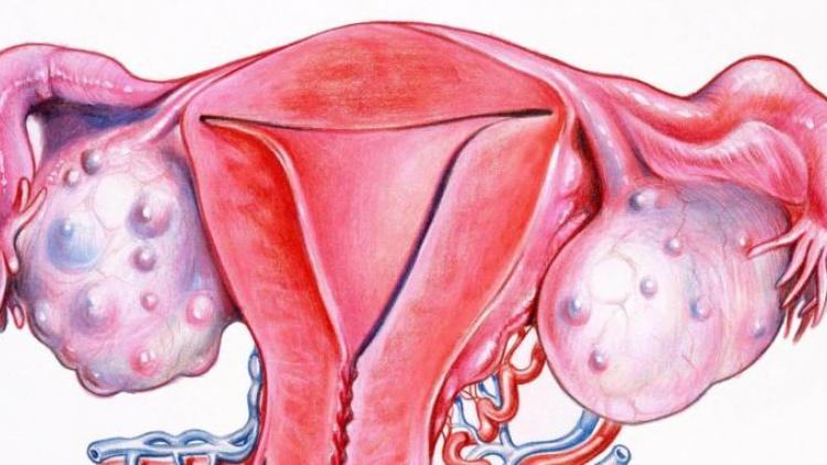 Параовариальная кіста яєчника: причини, симптоми і видалення