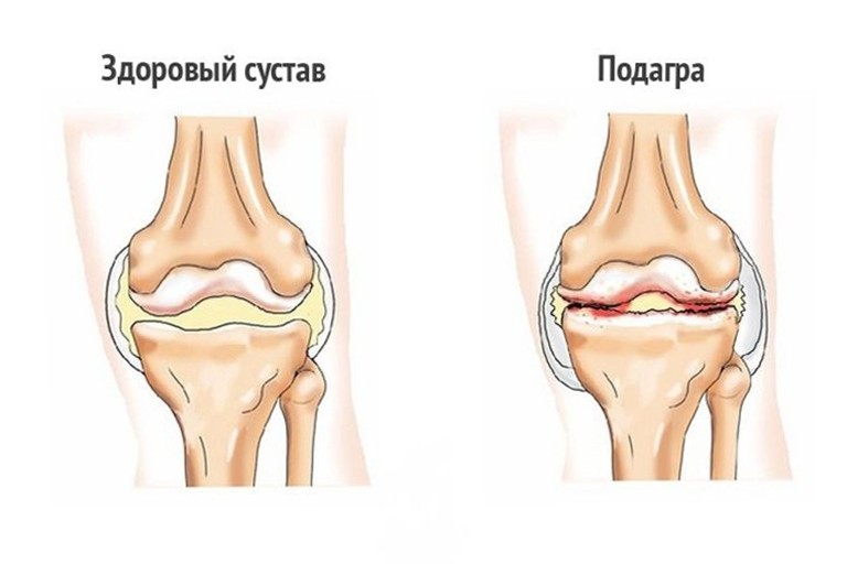 Подагра: що це таке, причини, симптоми і лікування