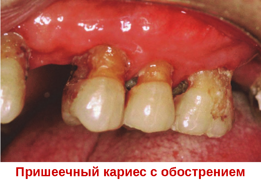Пришеечный карієс: фото, стадії, що робити і чи можна вилікувати