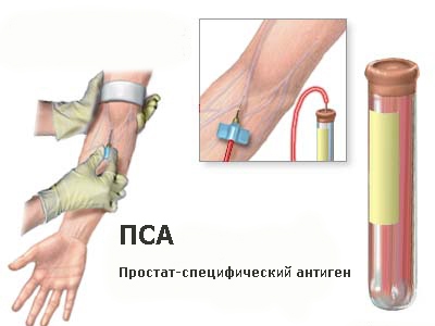 ПСА при раку простати: визначення і призначення аналізу