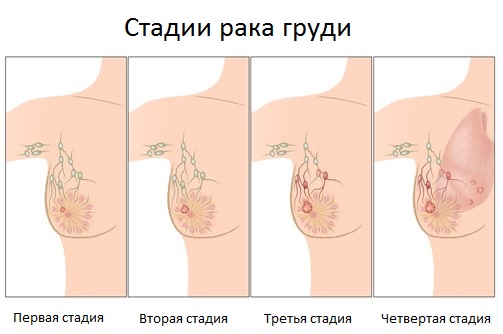 Пухлина молочної залози у жінок – всі причини з фото, лікування