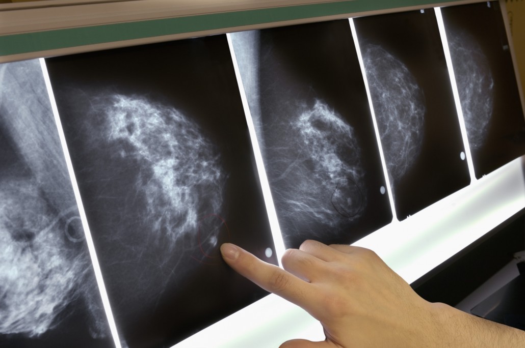 Рак сосочкового поля у жінок: фото, причини і методи лікування