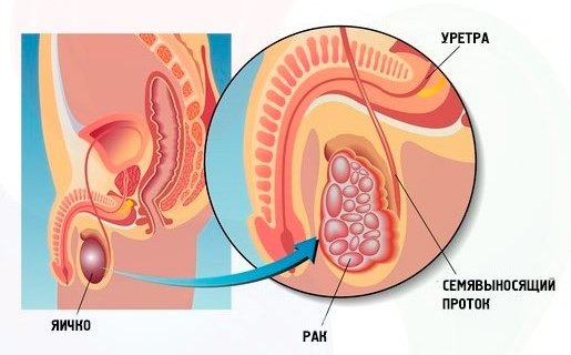 Рак яєчка у чоловіків – причини, лікування, фото, профілактика!