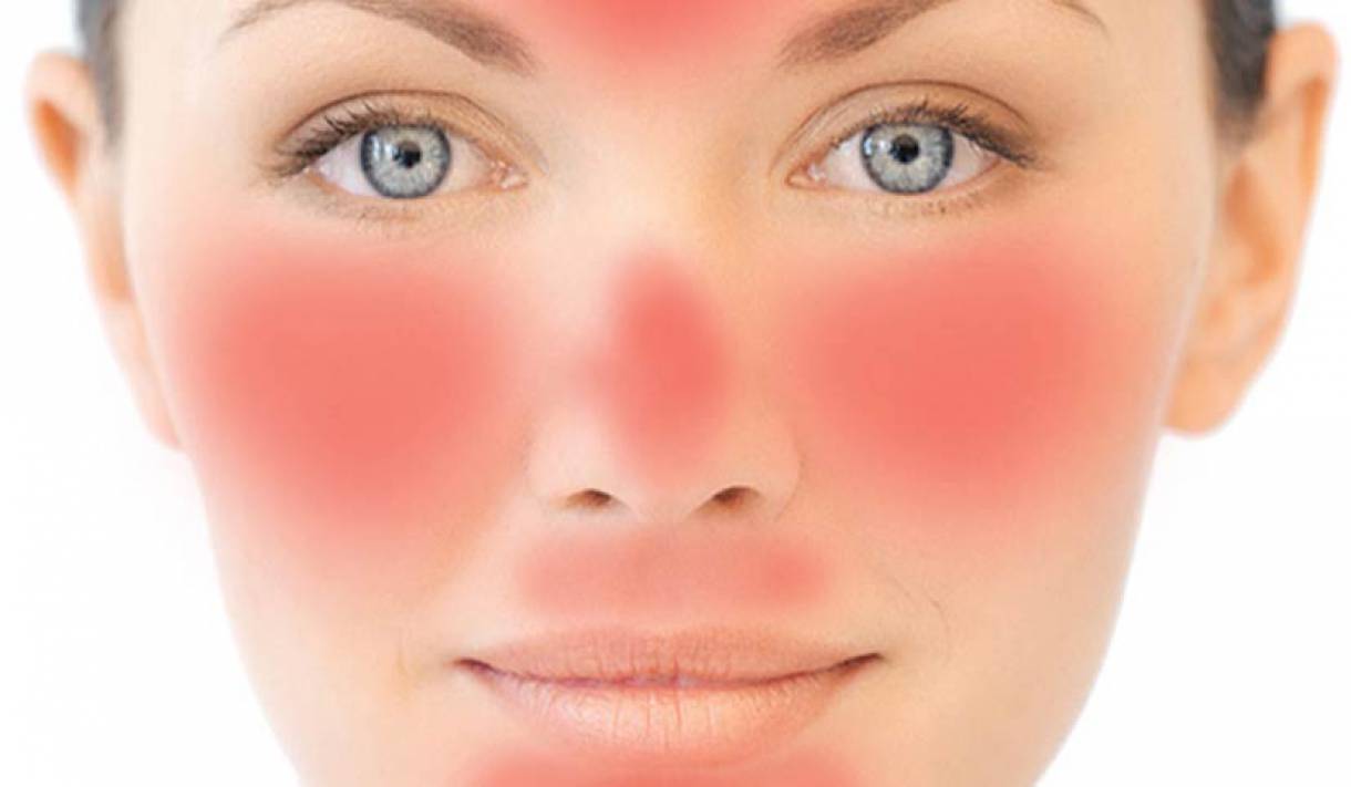 Розацеа на обличчі: лікування лазером, в домашніх умовах, препарати та симптоми