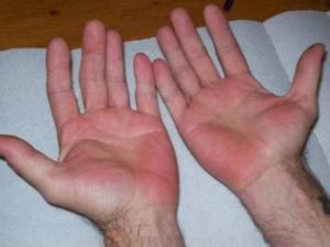 Що робити якщо сверблять червоні плями на долонях рук?
