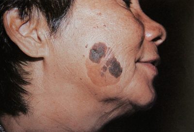 Що таке кератоз шкіри, види захворювання і методи лікування