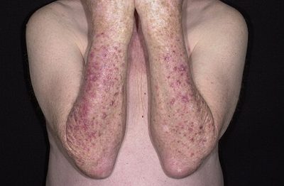 Що таке кератоз шкіри, види захворювання і методи лікування