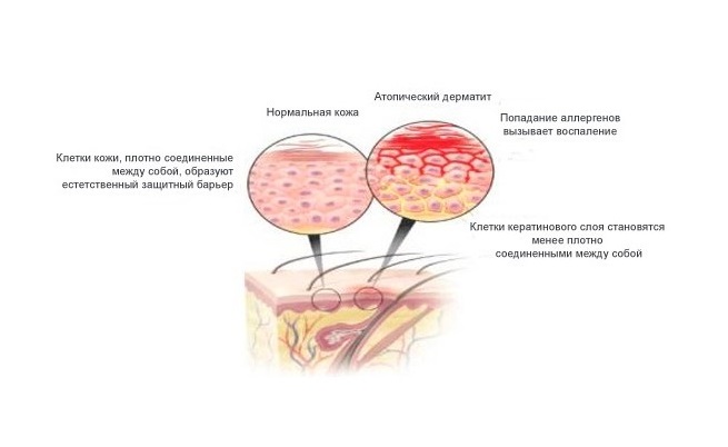 Симптоми та лікування дерматиту у дітей на шкірі