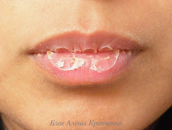Сухість губ. Причини і лікування народними засобами