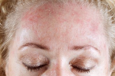 Свербить шкіра на обличчі — причини і способи лікування
