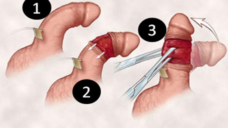 Травми статевого члена: види, фото, причини і що робити