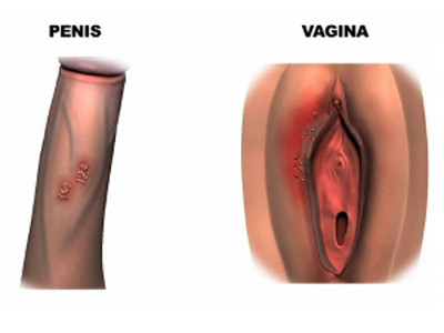 Як лікувати генітальний герпес: основні методи лікування