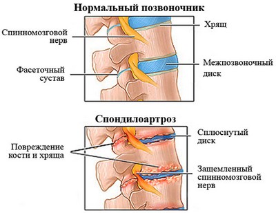 Як лікувати спондилоартроз попереково — крижового відділу хребта?