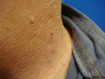 Як розпізнати і усунути лихенификацию шкіри?