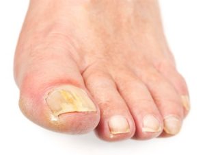 Як вилікувати грибок нігтів на ногах в домашніх умовах швидко?