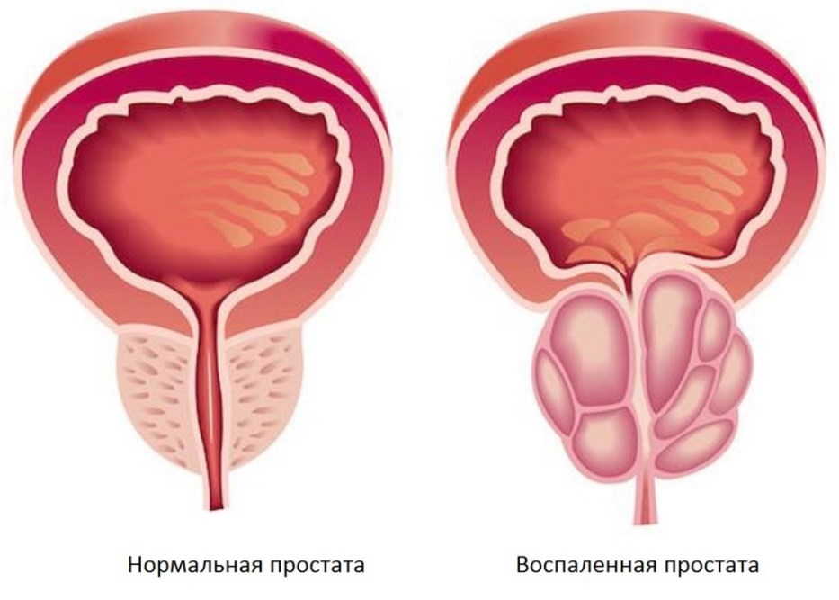 Захворювання нирок: особливості патологій у чоловіків